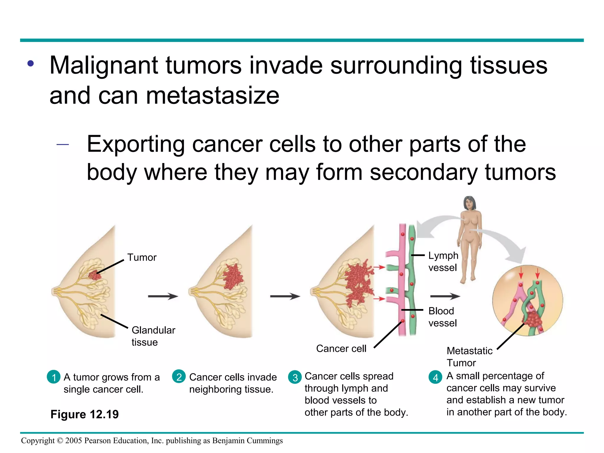 • Malignant tumors invade surrounding tissues
and can metastasize
– Exporting cancer cells to other parts of the
body where they may form secondary tumors

Lymph
vessel

Tumor

Blood
vessel

Glandular
tissue
1 A tumor grows from a
single cancer cell.

Cancer cell
2 Cancer cells invade
neighboring tissue.

Figure 12.19
Copyright © 2005 Pearson Education, Inc. publishing as Benjamin Cummings

3 Cancer cells spread
through lymph and
blood vessels to
other parts of the body.

Metastatic
Tumor
4 A small percentage of
cancer cells may survive
and establish a new tumor
in another part of the body.

 