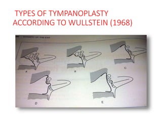 TYPES OF TYMPANOPLASTY
ACCORDING TO WULLSTEIN (1968)
 