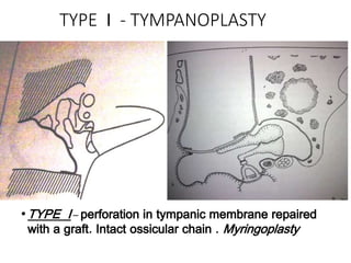 TYPE I - TYMPANOPLASTY
•TYPE I – perforation in tympanic membrane repaired
with a graft. Intact ossicular chain . Myringoplasty
 