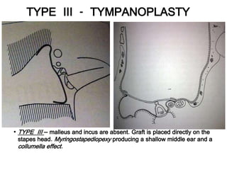 • TYPE III – malleus and incus are absent. Graft is placed directly on the
stapes head. Myringostapediopexy producing a shallow middle ear and a
collumella effect.
TYPE III - TYMPANOPLASTY
 