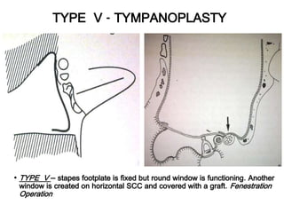 TYPE V - TYMPANOPLASTY
• TYPE V – stapes footplate is fixed but round window is functioning. Another
window is created on horizontal SCC and covered with a graft. Fenestration
Operation
 