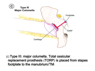 (C) Type III: major columella. Total ossicular
replacement prosthesis (TORP) is placed from stapes
footplate to the manubrium/TM.
 