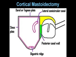 STEPS OF CAT
1. Cortical mastoidectomy
2. Anterior Tympanotomy : via tympanomeatal flap
3. Posterior Tympanotomy: via facial recess approach
4. Tympanoplasty
 