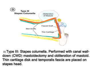 (D) Type III: Stapes columella. Performed with canal wall-
down (CWD) mastoidectomy and obliteration of mastoid.
Thin cartilage disk and temporalis fascia are placed on
stapes head.
 