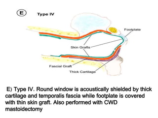(E) Type IV. Round window is acoustically shielded by thick
cartilage and temporalis fascia while footplate is covered
with thin skin graft. Also performed with CWD
mastoidectomy
 