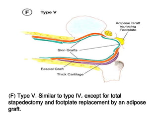 (F) Type V. Similar to type IV, except for total
stapedectomy and footplate replacement by an adipose
graft.
 