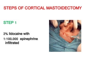 STEPS OF CORTICAL MASTOIDECTOMY
STEP 1
2% lidocaine with
1:100,000 epinephrine
infiltrated
 
