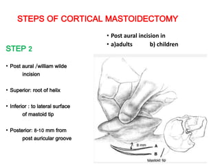 STEPS OF CORTICAL MASTOIDECTOMY
STEP 2
• Post aural /william wilde
incision
• Superior: root of helix
• Inferior : to lateral surface
of mastoid tip
• Posterior: 8-10 mm from
post auricular groove
• Post aural incision in
• a)adults b) children
 