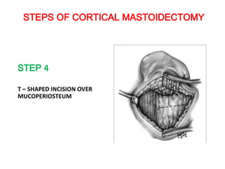 STEPS OF CORTICAL MASTOIDECTOMY
STEP 4
T – SHAPED INCISION OVER
MUCOPERIOSTEUM
 