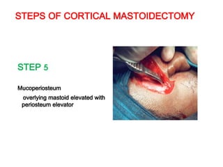STEPS OF CORTICAL MASTOIDECTOMY
STEP 5
Mucoperiosteum
overlying mastoid elevated with
periosteum elevator
 