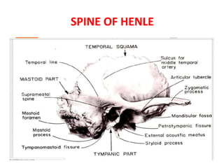 SPINE OF HENLE
 