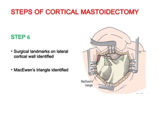 STEPS OF CORTICAL MASTOIDECTOMY
STEP 6
• Surgical landmarks on lateral
cortical wall identified
• MacEwen’s triangle identified
 