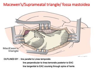 Macewen’s/Suprameatal triangle/ fossa mastoidea
OUTLINED BY : line parallel to Linea temporalis
line perpendicular to linea temoralis posterior to EAC
line tangential to EAC coursing through spine of henle
 