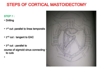 STEPS OF CORTICAL MASTOIDECTOMY
STEP 7 :
• Drilling
• 1st cut: parallel to linea temporalis
• 2nd cut : tangent to EAC
• 3rd cut : parallel to
course of sigmoid sinus connecting 1st
to cuts
•
 