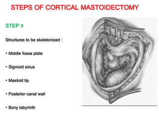 STEPS OF CORTICAL MASTOIDECTOMY
STEP 9
Structures to be skeletonized :
• Middle fossa plate
• Sigmoid sinus
• Mastoid tip
• Posterior canal wall
• Bony labyrinth
 