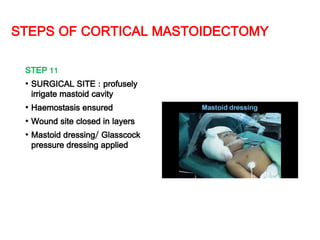 STEPS OF CORTICAL MASTOIDECTOMY
STEP 11
• SURGICAL SITE : profusely
irrigate mastoid cavity
• Haemostasis ensured
• Wound site closed in layers
• Mastoid dressing/ Glasscock
pressure dressing applied
 
