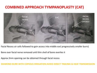 COMBINED APPROACH TYMPANOPLASTY (CAT)
Facial
recess
EAC FACIAL
RECESS
OPENED
Facial Recess air cells followed to gain access into middle ear( progressively smaller burrs)
Bone over facial nerve removed until thin shell of bone overlies it
Approx 2mm opening can be obtained through facial recess
DIAMOND BURR WITH COPIOUS IRRIGATION:AVOID DIRECT TRAUMA & HEAT TRANSMISSION
 