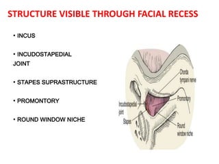 STRUCTURE VISIBLE THROUGH FACIAL RECESS
• INCUS
• INCUDOSTAPEDIAL
JOINT
• STAPES SUPRASTRUCTURE
• PROMONTORY
• ROUND WINDOW NICHE
 