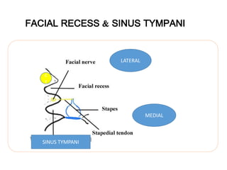 FACIAL RECESS & SINUS TYMPANI
LATERAL
MEDIAL
c
t
SINUS TYMPANI
 