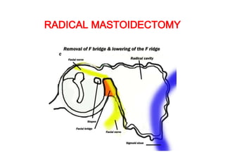 RADICAL MASTOIDECTOMY
 