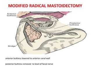 MODIFIED RADICAL MASTOIDECTOMY
anterior buttress lowered to anterior canal wall
posterior buttress removed to level of facial nerve
 