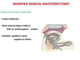 MODIFIED RADICAL MASTOIDECTOMY
Drilling over posterior canal wall:
• Large cutting burr
• Bone removal begun inside of
EAC on anterosuperior surface
• Direction :parallel to nerve
superior to inferior
 