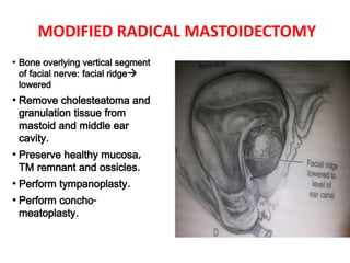 MODIFIED RADICAL MASTOIDECTOMY
• Bone overlying vertical segment
of facial nerve: facial ridge
lowered
• Remove cholesteatoma and
granulation tissue from
mastoid and middle ear
cavity.
• Preserve healthy mucosa,
TM remnant and ossicles.
• Perform tympanoplasty.
• Perform concho-
meatoplasty.
 
