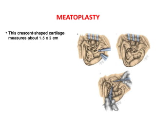 MEATOPLASTY
• This crescent-shaped cartilage
measures about 1.5 x 2 cm
 