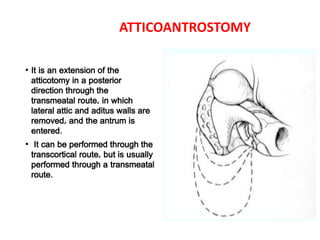 ATTICOANTROSTOMY
• It is an extension of the
atticotomy in a posterior
direction through the
transmeatal route, in which
lateral attic and aditus walls are
removed, and the antrum is
entered.
• It can be performed through the
transcortical route, but is usually
performed through a transmeatal
route.
 