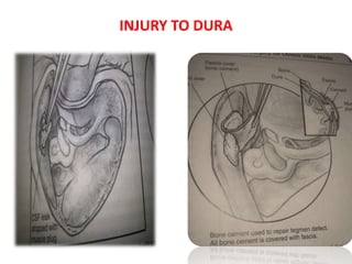 INJURY TO DURA
 