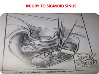 INJURY TO SIGMOID SINUS
 