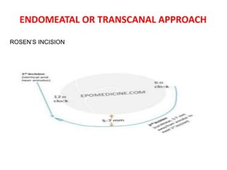 ENDOMEATAL OR TRANSCANAL APPROACH
ROSEN’S INCISION
 