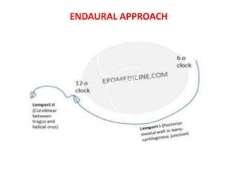 ENDAURAL APPROACH
 