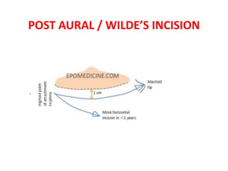 POST AURAL / WILDE’S INCISION
 