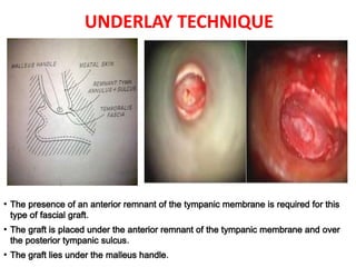UNDERLAY TECHNIQUE
• The presence of an anterior remnant of the tympanic membrane is required for this
type of fascial graft.
• The graft is placed under the anterior remnant of the tympanic membrane and over
the posterior tympanic sulcus.
• The graft lies under the malleus handle.
 