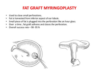 FAT GRAFT MYRINGOPLASTY
 