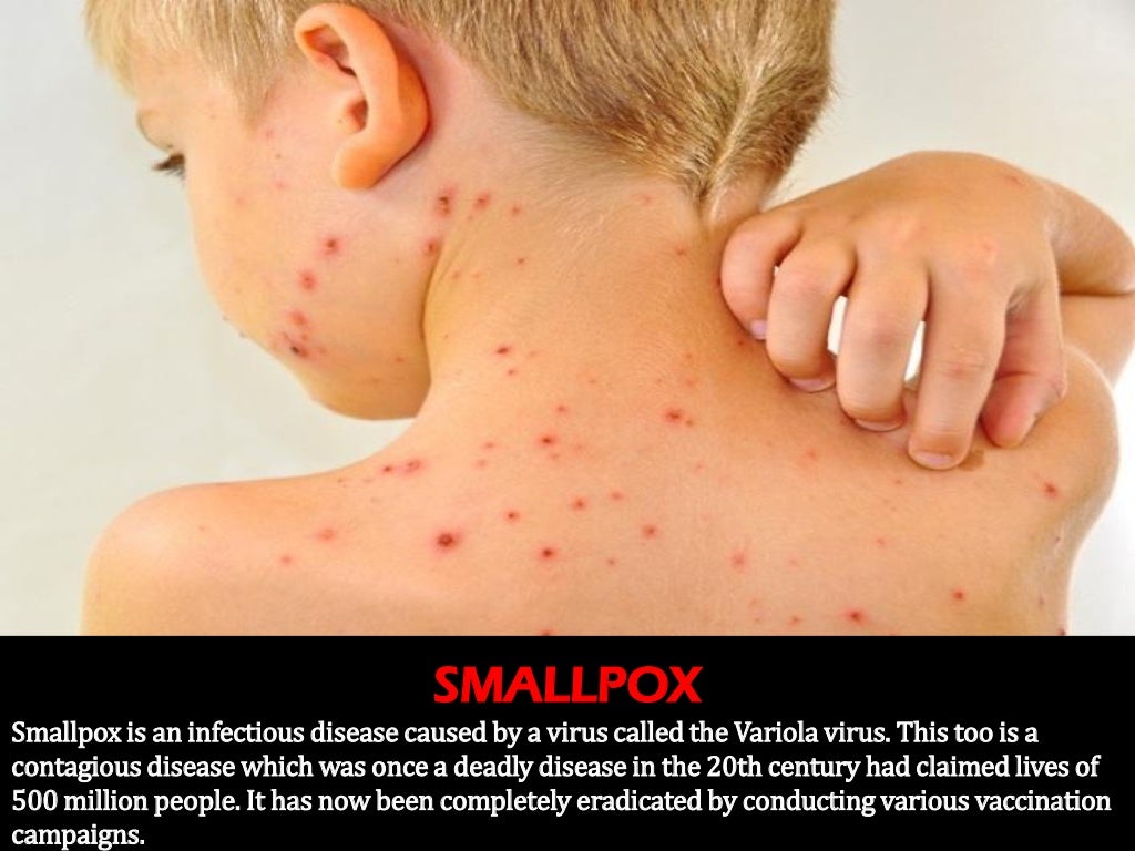 SMALLPOX Smallpox is an infectious