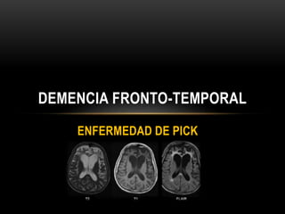 ENFERMEDAD DE PICK
DEMENCIA FRONTO-TEMPORAL
 