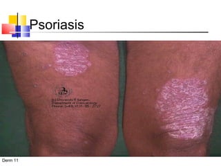 Psoriasis 