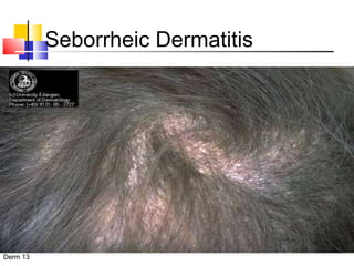 Seborrheic Dermatitis 