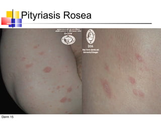 Pityriasis Rosea 