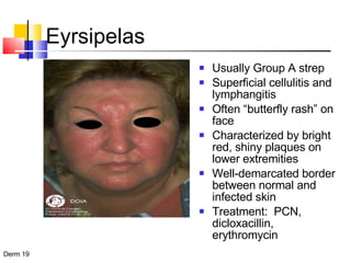 Eyrsipelas Usually Group A strep Superficial cellulitis and lymphangitis Often “butterfly rash” on face Characterized by bright red, shiny plaques on lower extremities Well-demarcated border between normal and infected skin Treatment:  PCN, dicloxacillin, erythromycin 