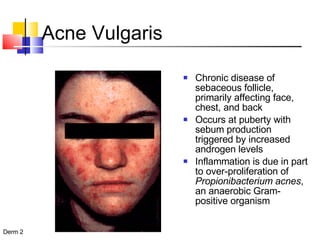 Acne Vulgaris Chronic disease of sebaceous follicle, primarily affecting face, chest, and back Occurs at puberty with sebum production triggered by increased androgen levels Inflammation is due in part to over-proliferation of  Propionibacterium acnes , an anaerobic Gram-positive organism 