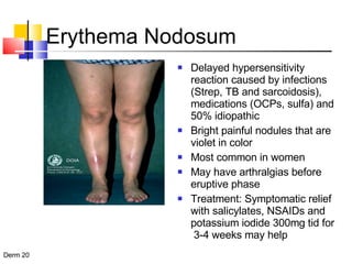 Erythema Nodosum Delayed hypersensitivity reaction caused by infections (Strep, TB and sarcoidosis), medications (OCPs, sulfa) and 50% idiopathic Bright painful nodules that are violet in color Most common in women  May have arthralgias before eruptive phase Treatment: Symptomatic relief with salicylates, NSAIDs and potassium iodide 300mg tid for  3-4 weeks may help 