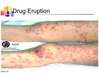 Drug Eruption 