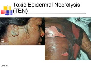 Toxic Epidermal Necrolysis (TEN) 