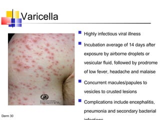 Varicella Highly infectious viral illness  Incubation average of 14 days after exposure by airborne droplets or vesicular fluid, followed by prodrome of low fever, headache and malaise Concurrent macules/papules to vesicles to crusted lesions Complications include encephalitis, pneumonia and secondary bacterial infections 