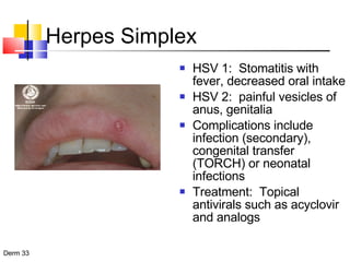 Herpes Simplex HSV 1:  Stomatitis with fever, decreased oral intake HSV 2:  painful vesicles of anus, genitalia Complications include infection (secondary), congenital transfer (TORCH) or neonatal infections Treatment:  Topical antivirals such as acyclovir and analogs 