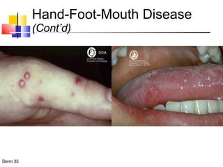 Hand-Foot-Mouth Disease  (Cont’d) 