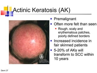 Actinic Keratosis (AK) Premalignant Often more felt than seen Rough, scaly and erythematous patches, poorly defined borders Increased incidence in fair skinned patients 5-20% of AKs will transform to SCC within 10 years 